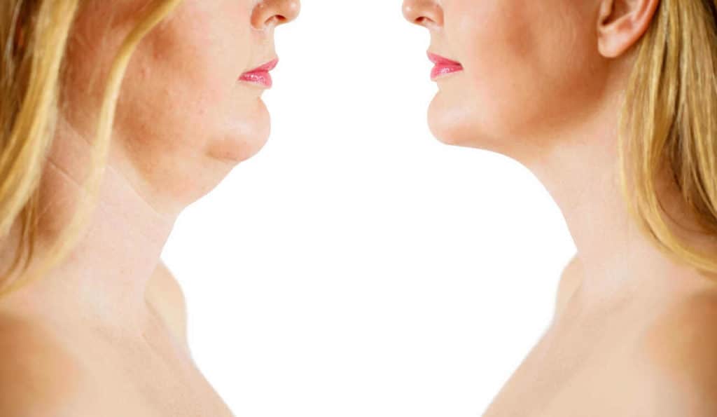 Double Chin treatment Bexhill before and after results