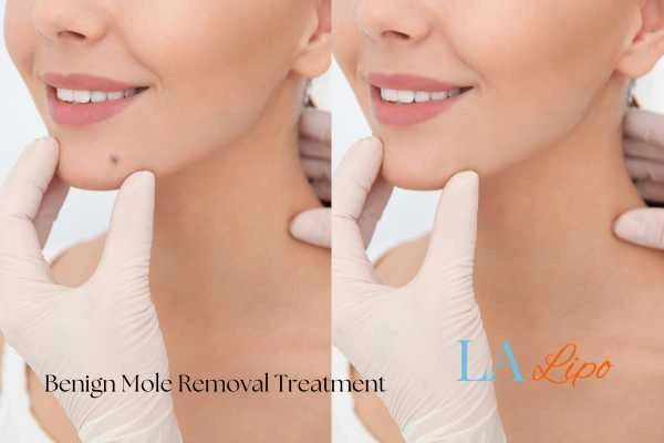 woman's before and after mole removal Bexhill results