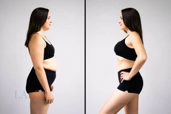 image of woman before and after results of LA-EMS Body Sculpting Bexhill to help treat Diastasis recti