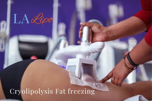 women getting fat freezing Bexhill