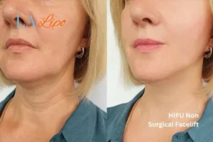 hi-fu for wrinkles Bexhill before and after results