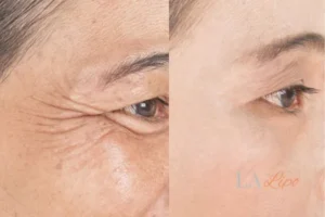 Before and after results of woman - HI-fu wrinkles reduction treatment Bexhill