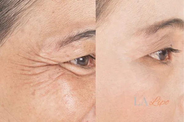 Before and after results of woman - HI-fu wrinkles reduction treatment Bexhill
