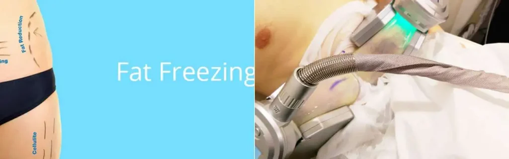 Fat freezing Bexhill on multiple areas of the body