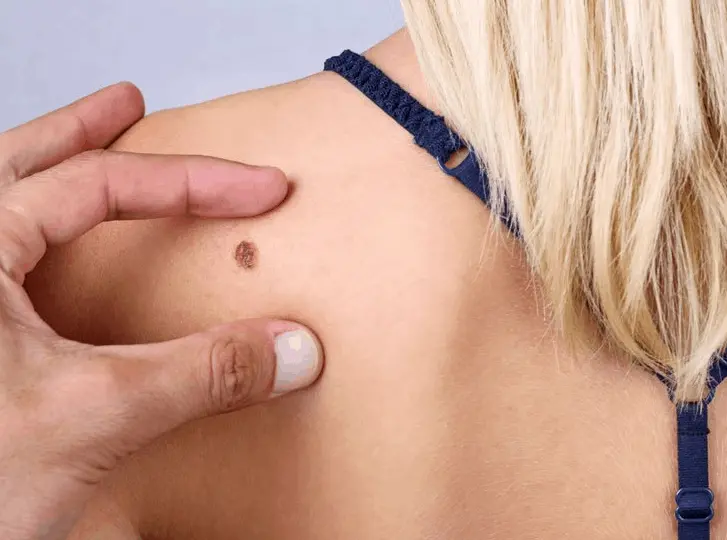 woman having mole removal Bexhill consultation before treatment.