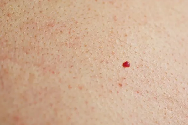 close up of a cherry angioma Bexhill