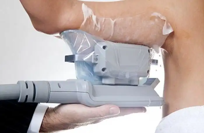 Picture of fat freezing Bexhill on the upper arms.