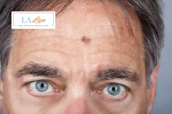 Solar Lentigo Removal Bexhill image of man with mark on his forehead