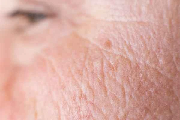 close up picture of a woman's face showing an age spot Bexhill