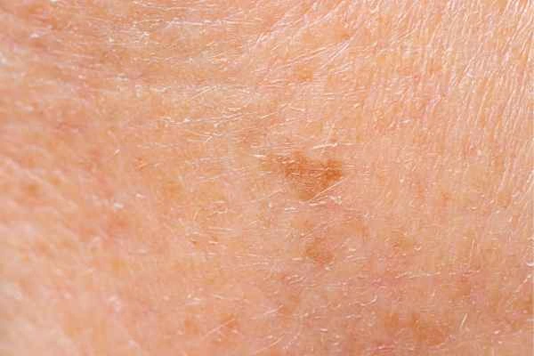 close up picture of age spots Bexhill