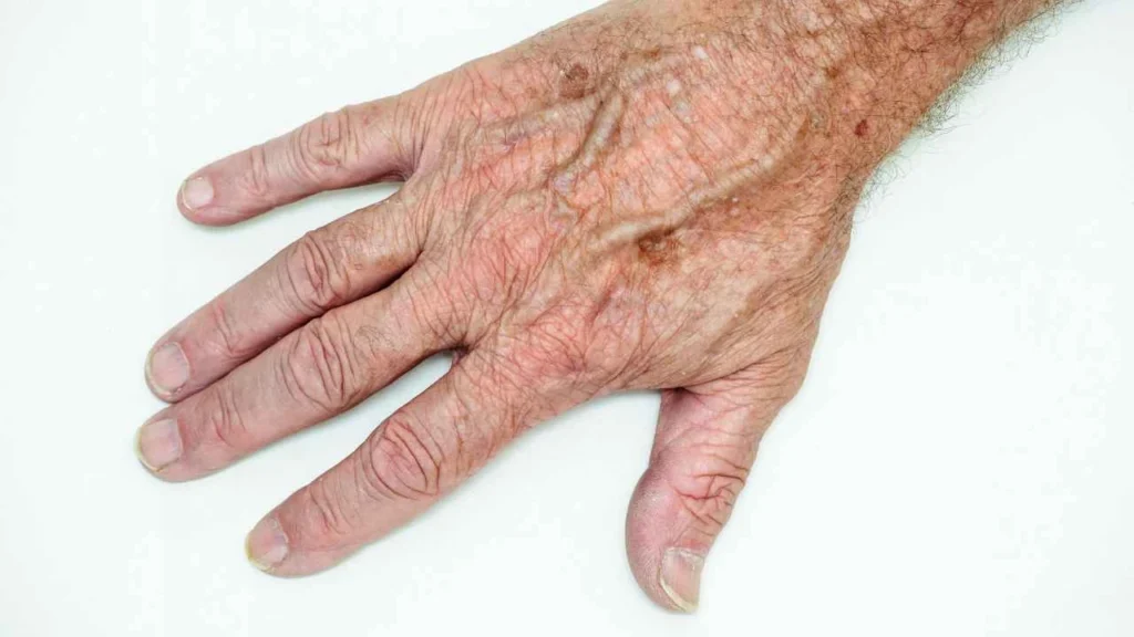 Male hand showing age spot Bexhill