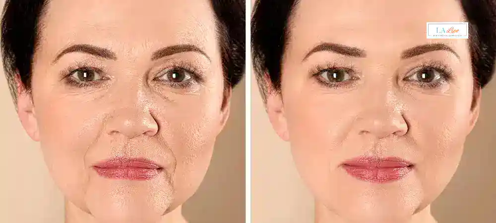 How Long Does It Take to See Results and How Long Do They Last Bexhill?