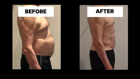 What Symptoms Can Diastasis Recti Cause in Men? Weak Core, Back Pain and Poor Posture Bexhill